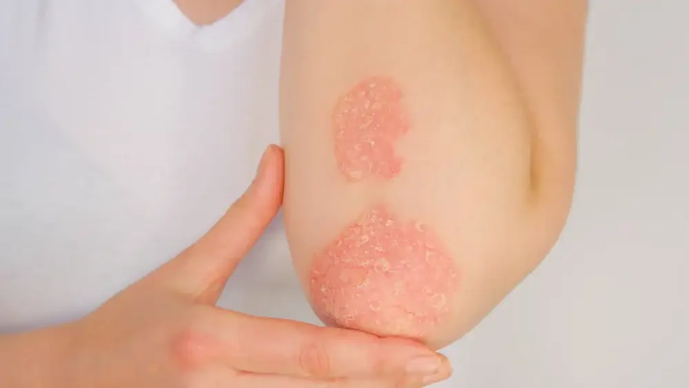 Psoriasis - autoimmune disease