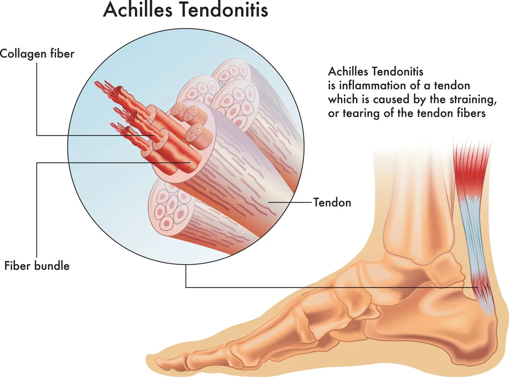 Tendonitis