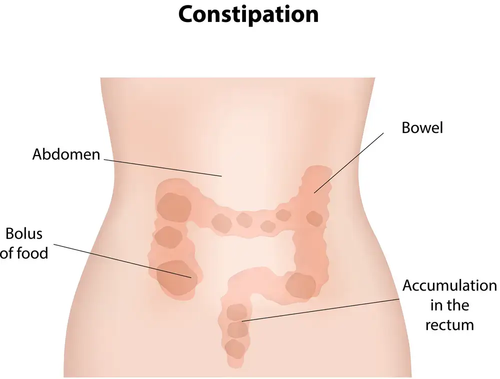 Constipation Constipation