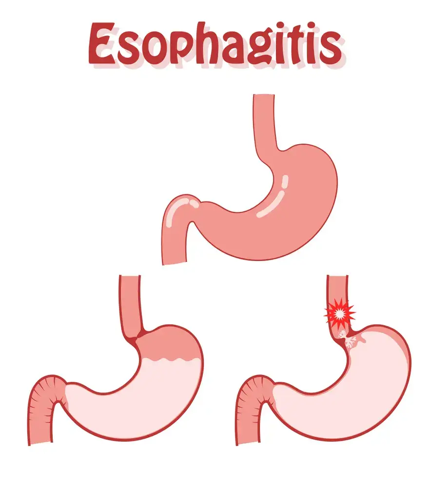 Esophagitis Esophagitis