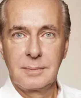 skin-boosters-after