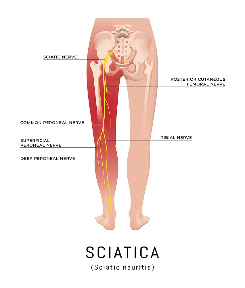 Sciatica pain