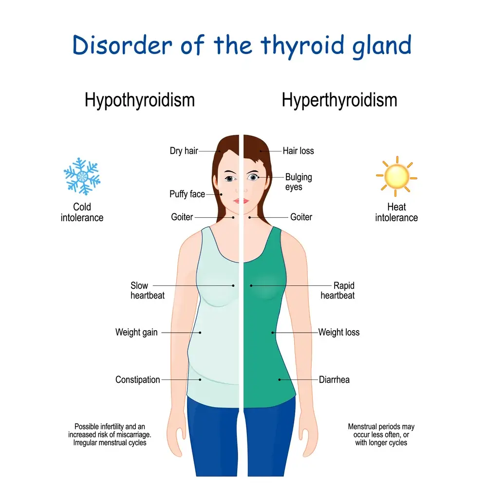 Thyroid-issues-Hyperthyroidism-Hypothyroidism Burlington Acne Clinic Treatment