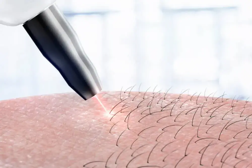 Benefits-of-Laser-Hair-Removal