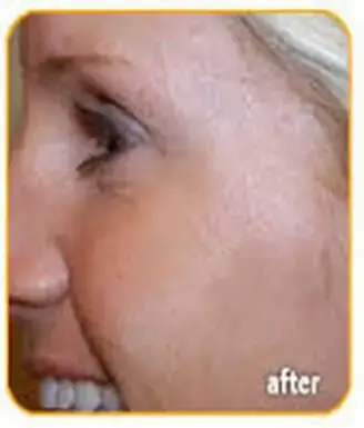 botox-after