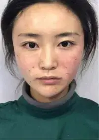 thread-lift-after