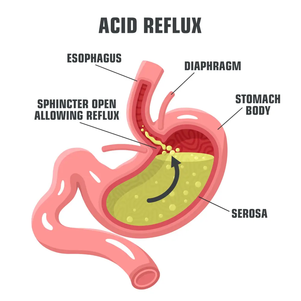 Acid-Reflux