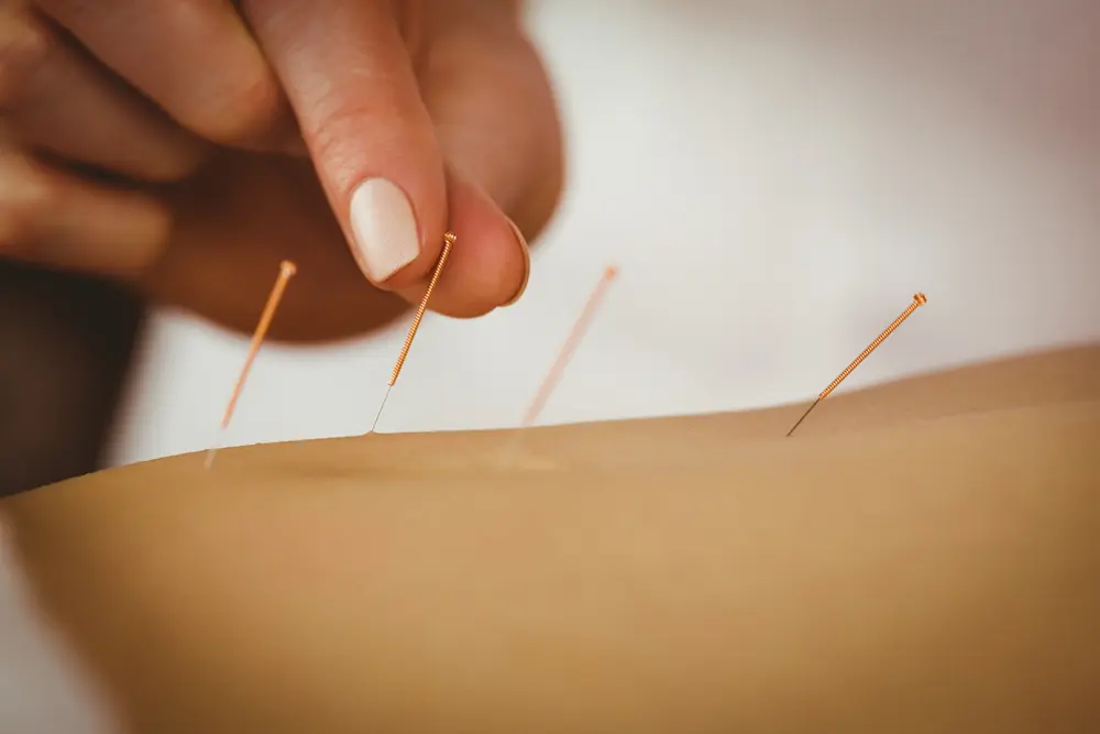 Acupuncture-Needles-in-the-stomach-for-digestive-conditions