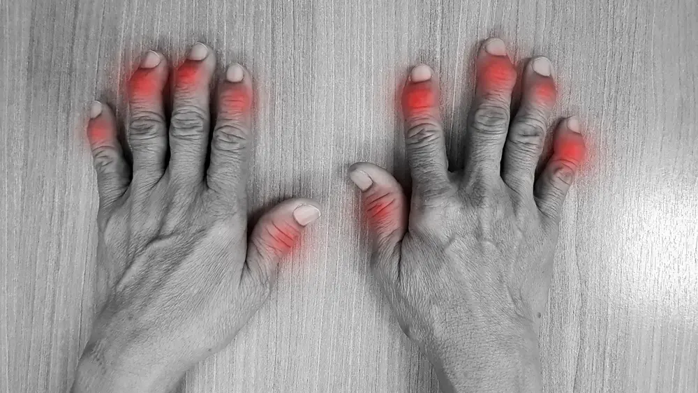 Arthritis-in-Hands