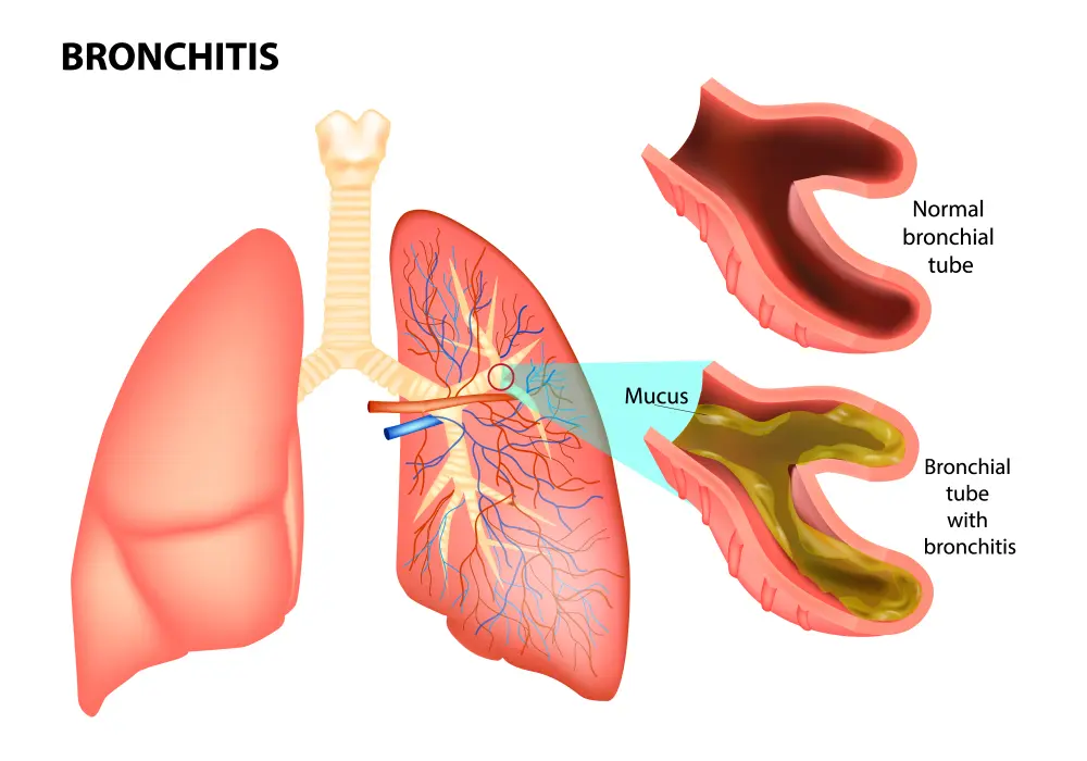 Bronchitis Treatment