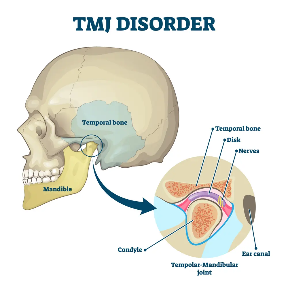 Temporo-Mandibular-Joint-TMJ-Jaw-Pain