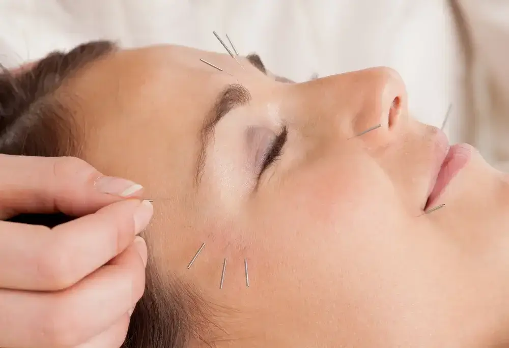 cosmetic-acupuncture
