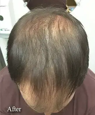 hair-restoration-after