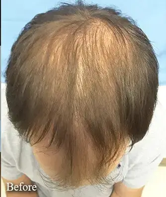 hair-restoration-before