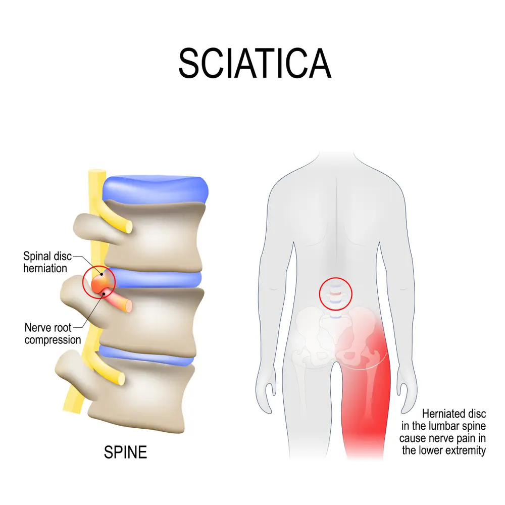 sciatica.-scheme-with-vertebrae-disks-and-nerves.-Human-body-from-back.-Disc-degeneration.-normal-wear-and-tear-process-of-aging-spine.