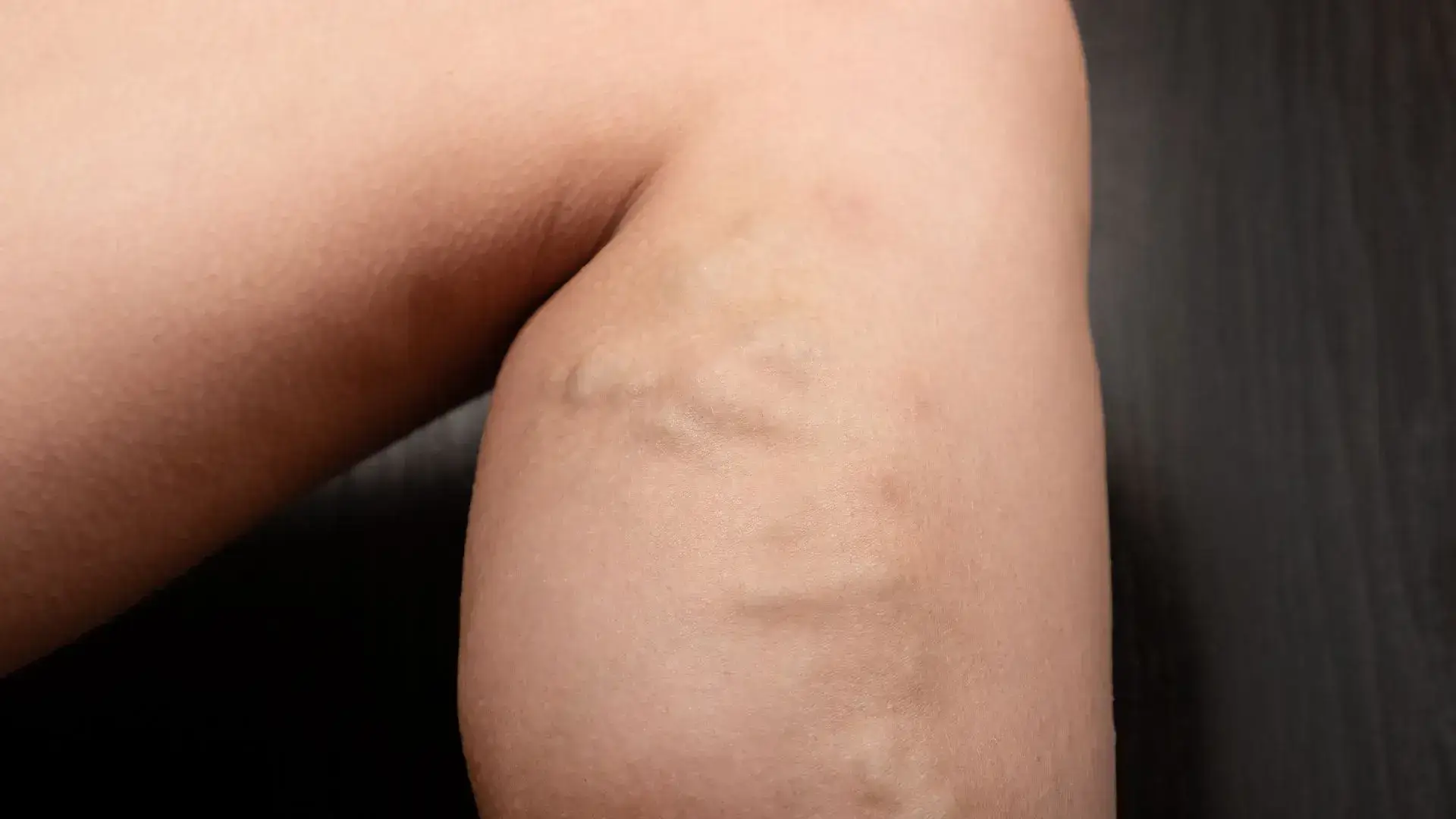 Varicose Veins
