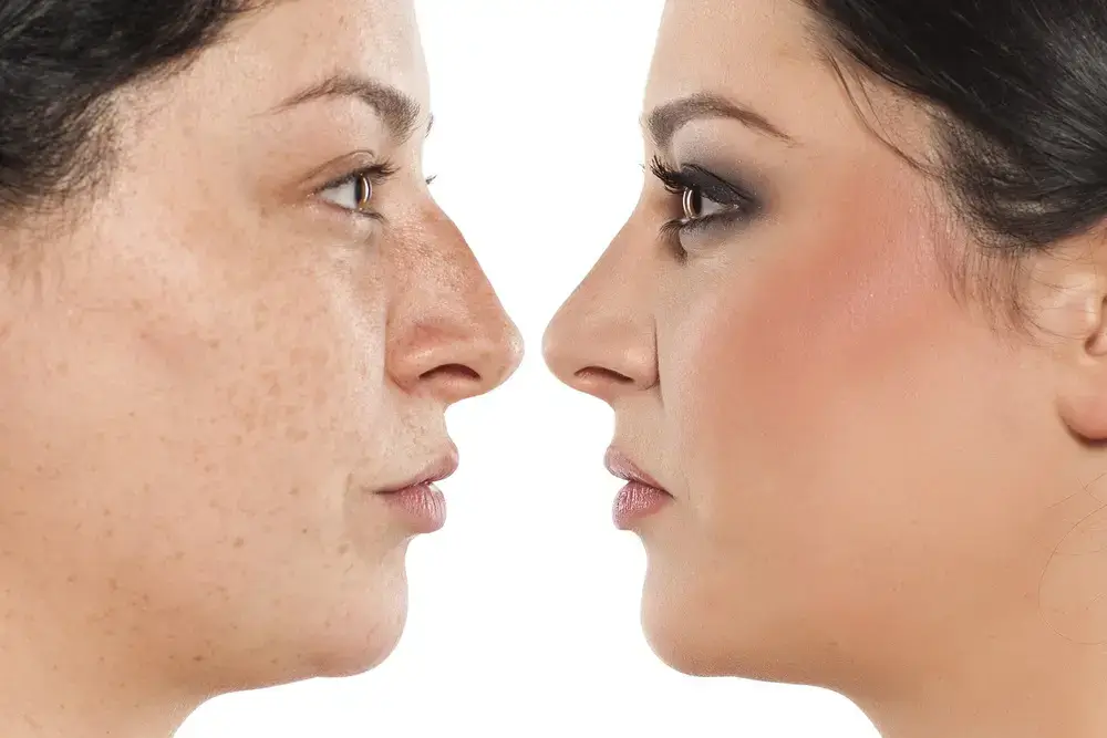 Georgetown Acne Clinic Treatment