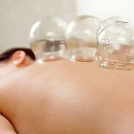 Wet Cupping