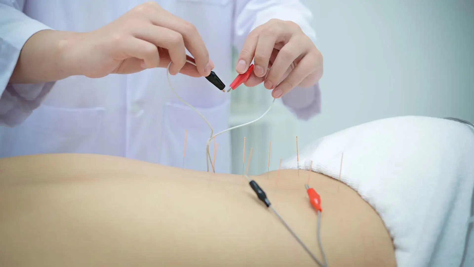 Acupuncture-for-Low-Back-Pain-Treatment