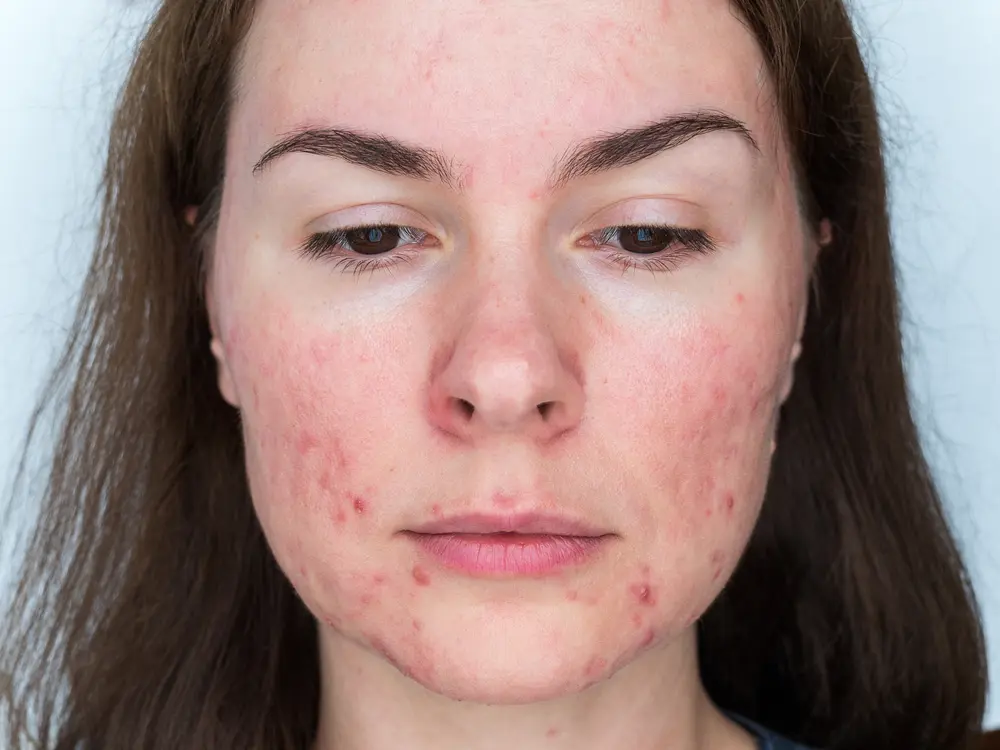 Acne-rosacea