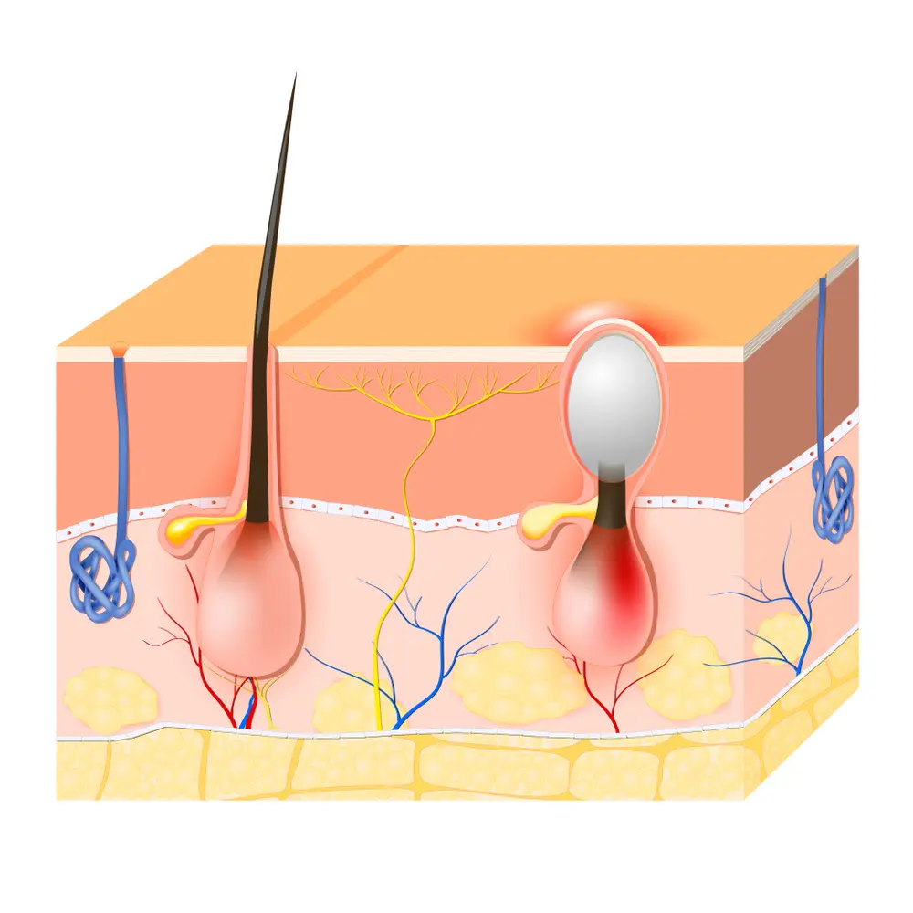 Acne-vulgaris