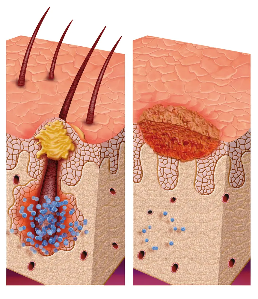 Pityrosporum-folliculitis