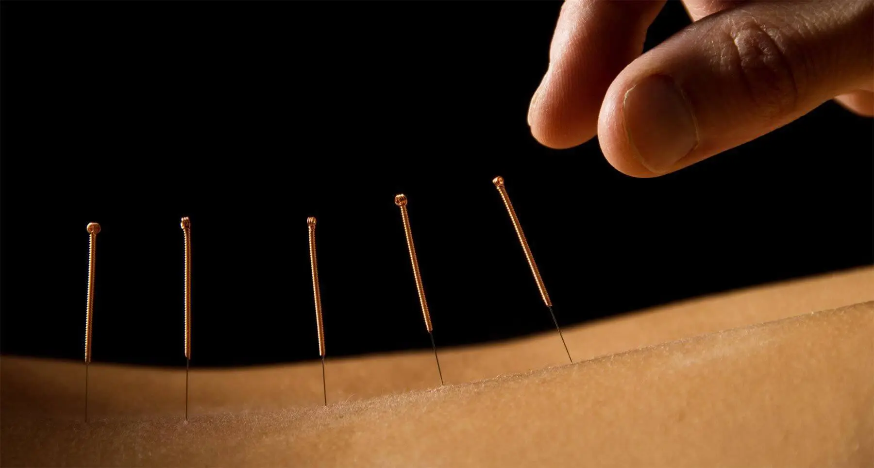 acupuncture