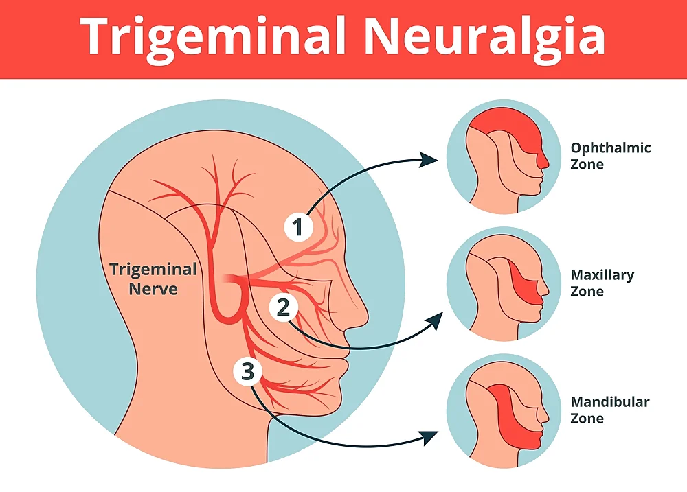 Trigeminal Neuralgia