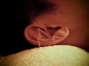 Acupuncture-Benefits