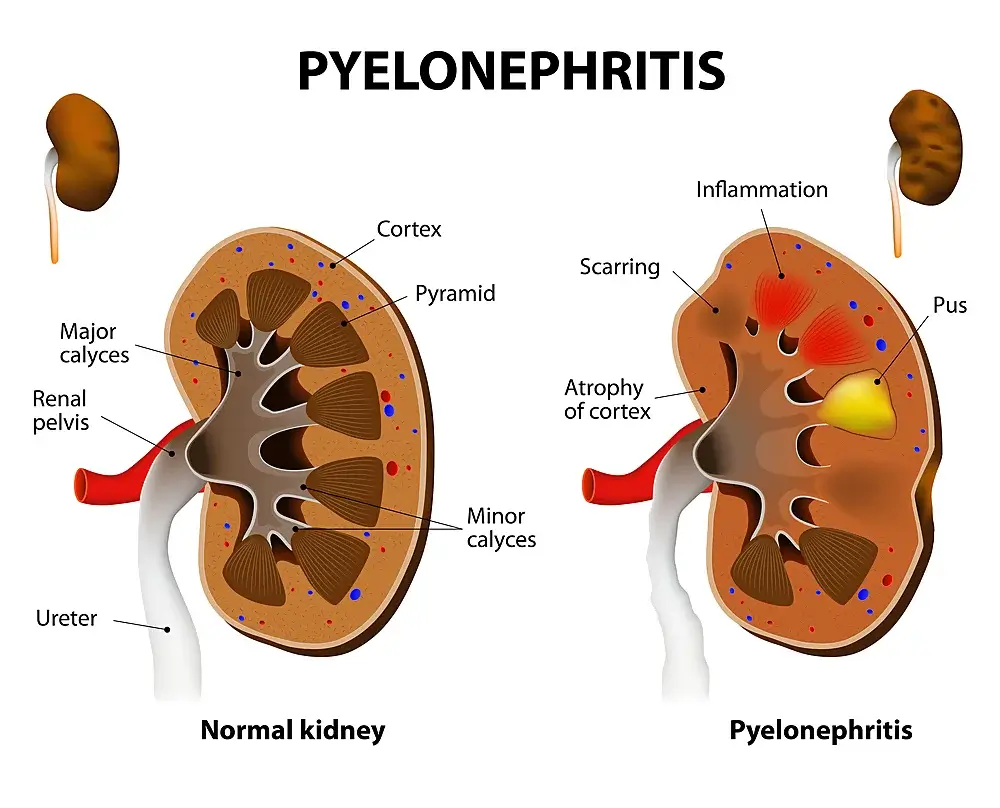 Pyelonephritis Pyelonephritis