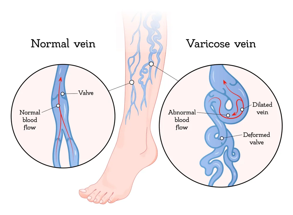 Varicose veins