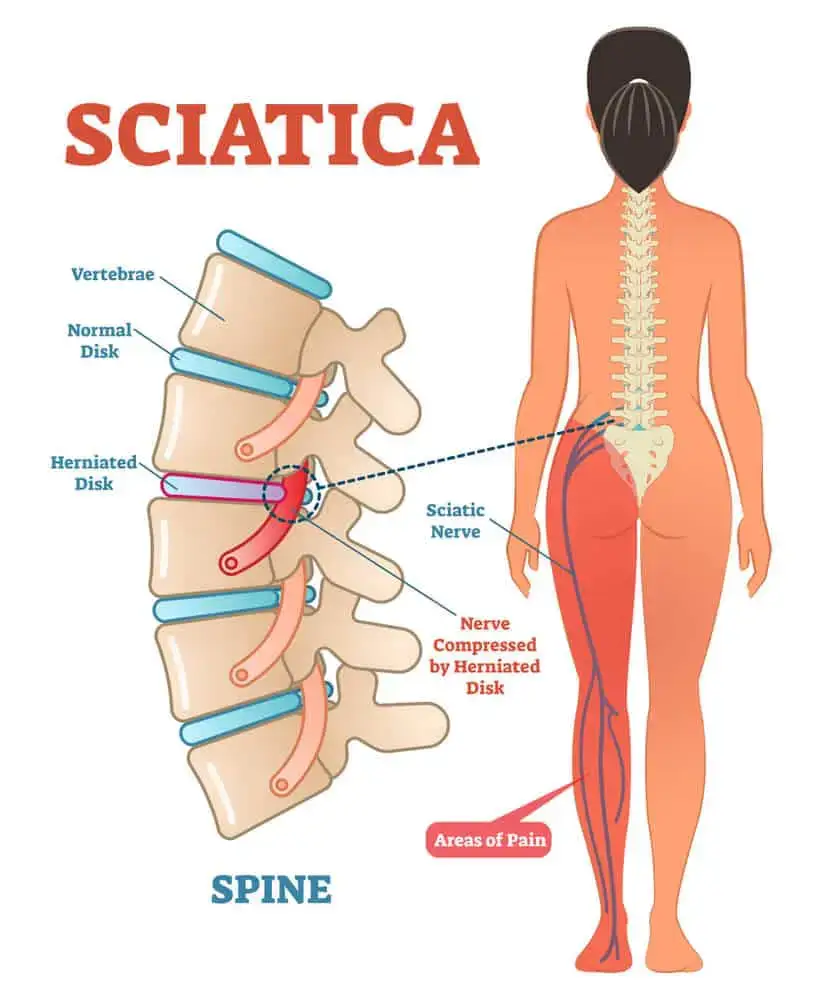 Chiropractic-for-Sciatica