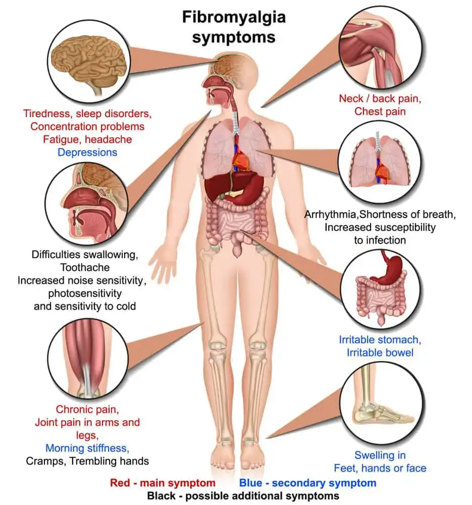 Chiropractic-treatment-for-Fibromyalgia