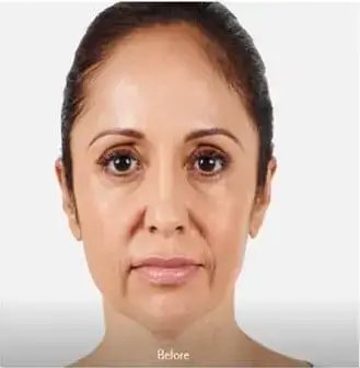 Juvederm-before