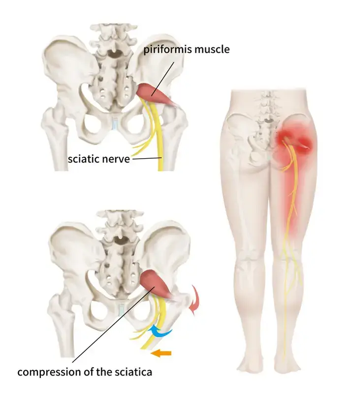 Sciatica-Complications