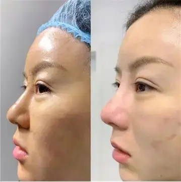 Thread-rhinoplasty-1