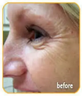 botox-before
