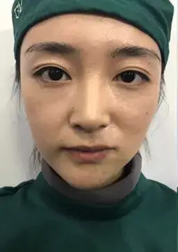 thread-lift-before