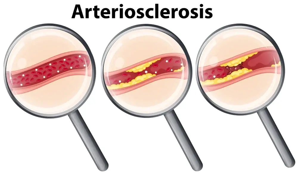 Arteriosclerosis Milton Acne Clinic Treatment