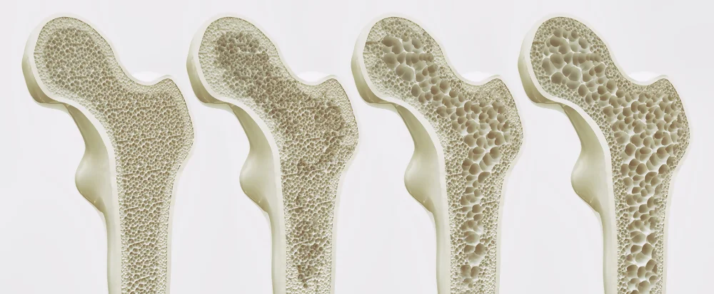 four-stages-osteoporosis four-stages-osteoporosis