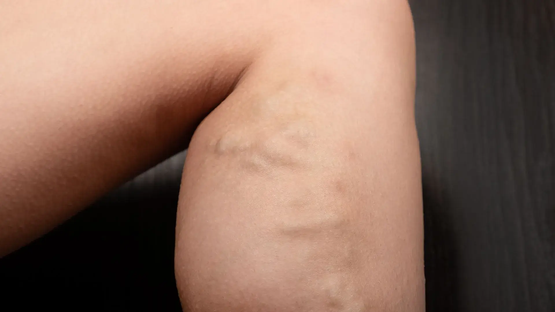 Varicose-veins