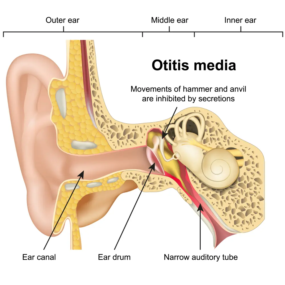 Pediatric Otitis Media (OM)