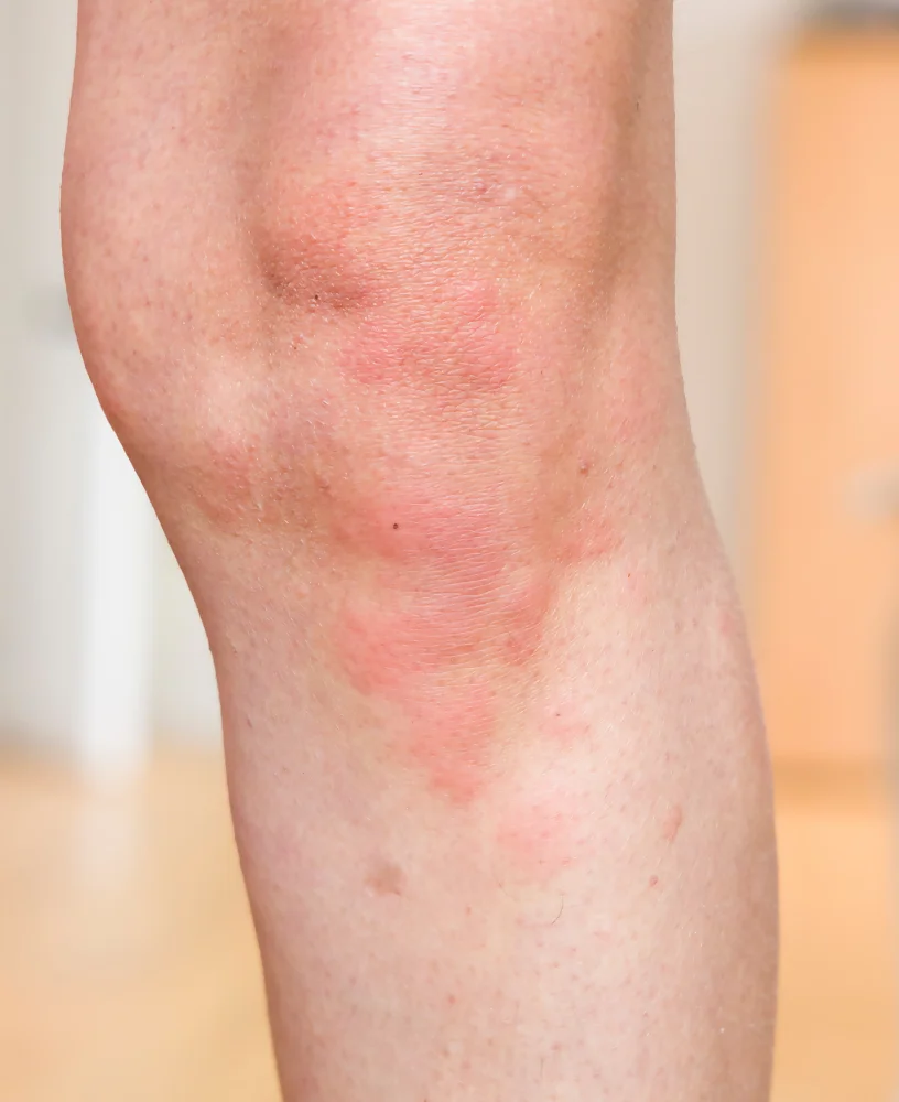 Hives - red rash