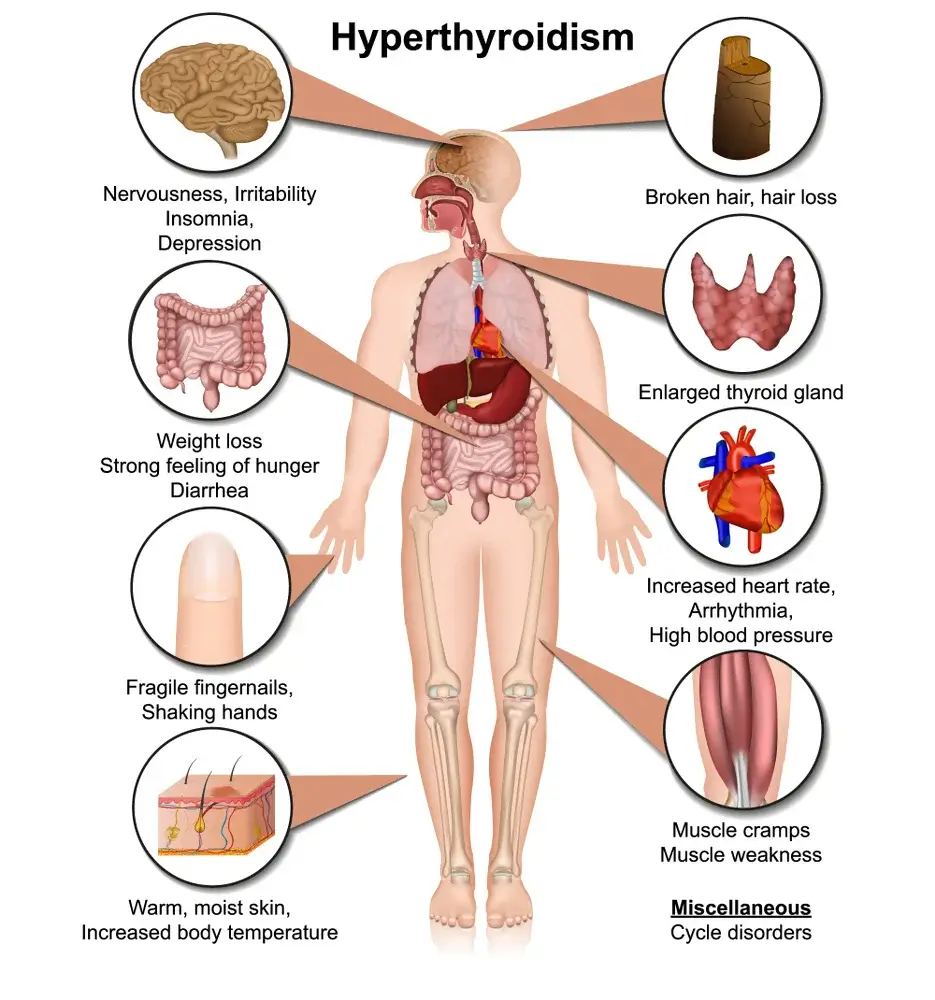 Thyroid-issues-Hyperthyroidism Mississauga Acne Clinic Treatment