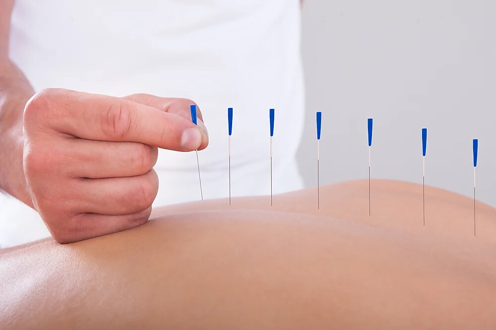 Acupuncture Clinic