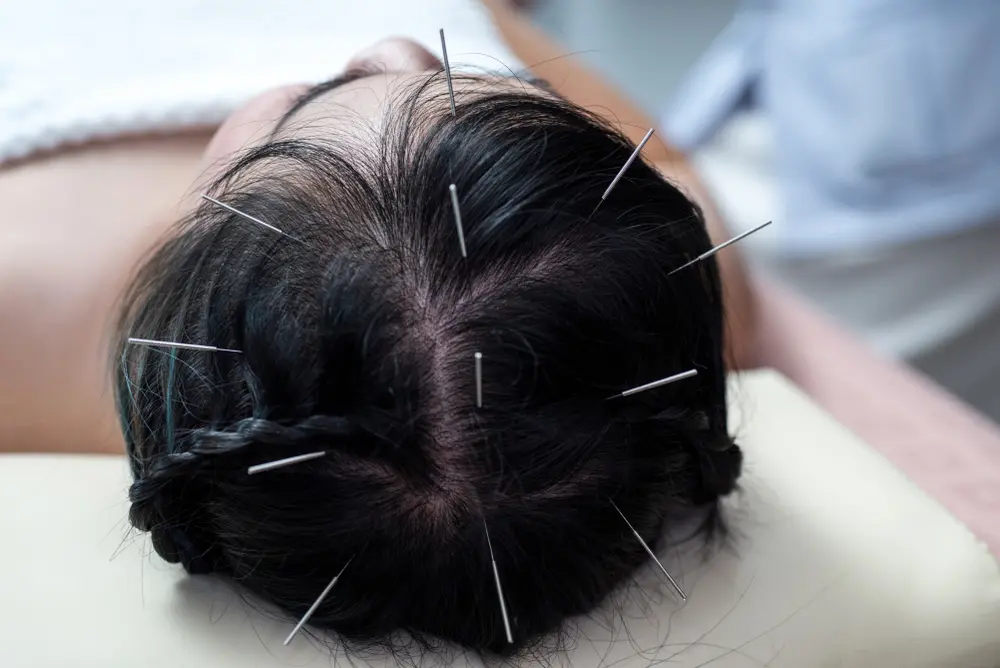 Benefits-of-Acupuncture-treatment-for-Neurological-symptoms