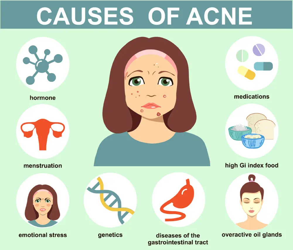 Causes-of-Acne
