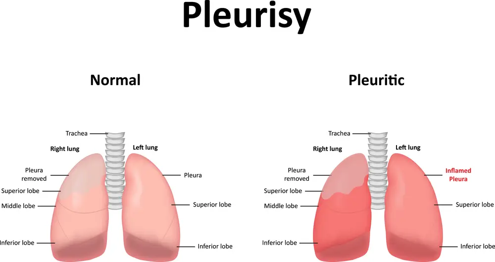 Pleurisy Treatment
