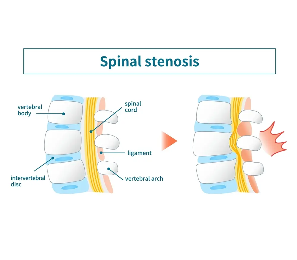 Spinal-Stenosis
