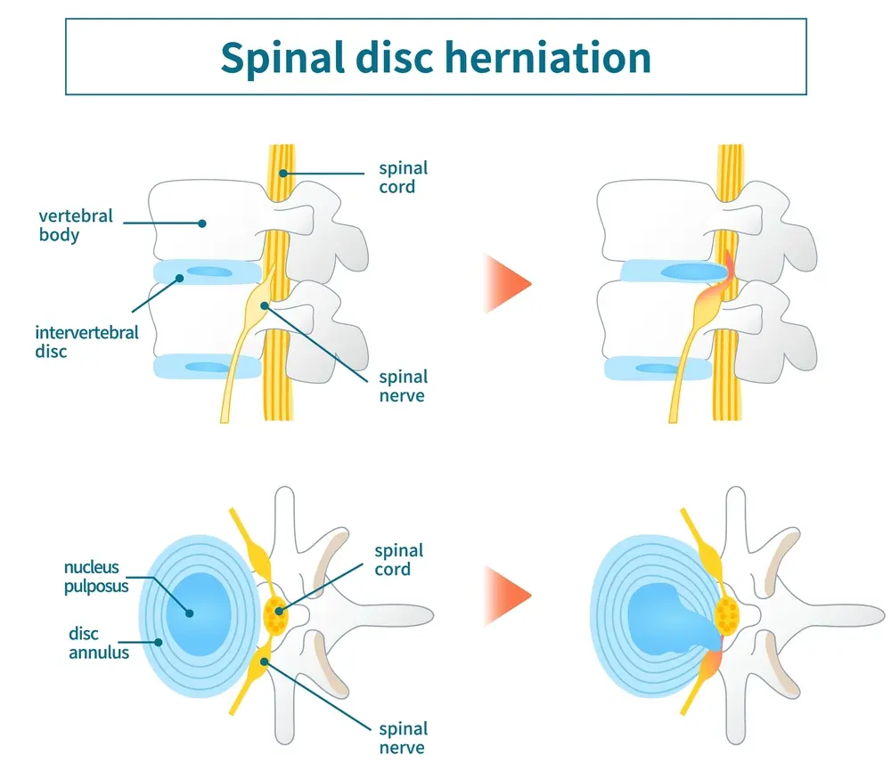Spinal-disc-herniation